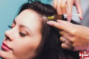 درمان ریزش مو با سلول های بنیادی